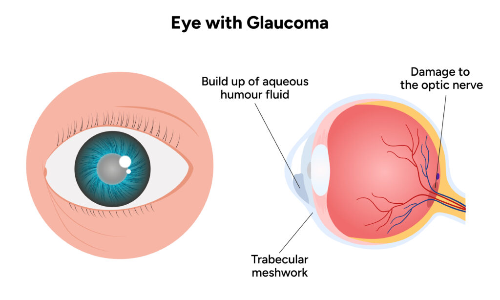 Glaucoma Complications Uncovered: Essential Information You Need to ...